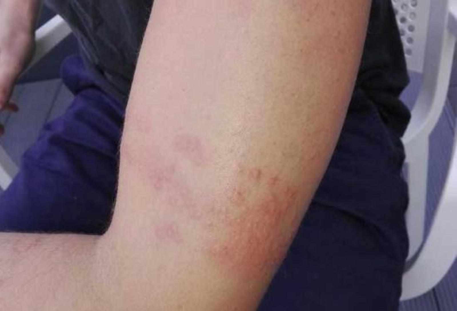 Punto da una medusa, odissea ospedaliera