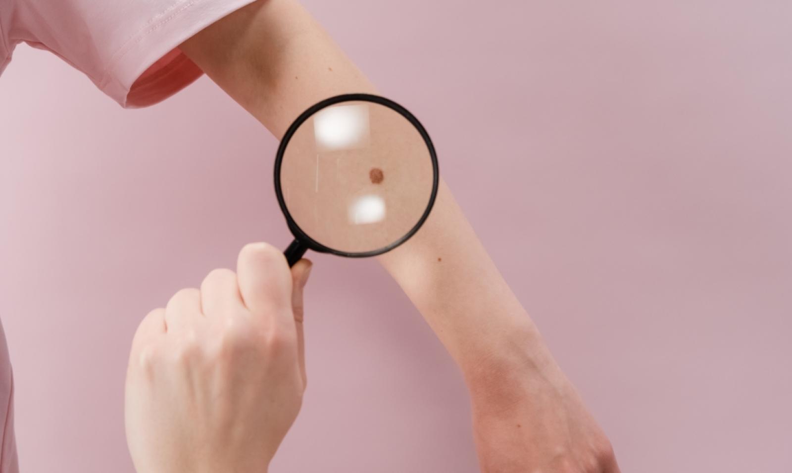 Controlli della pelle contro il melanoma