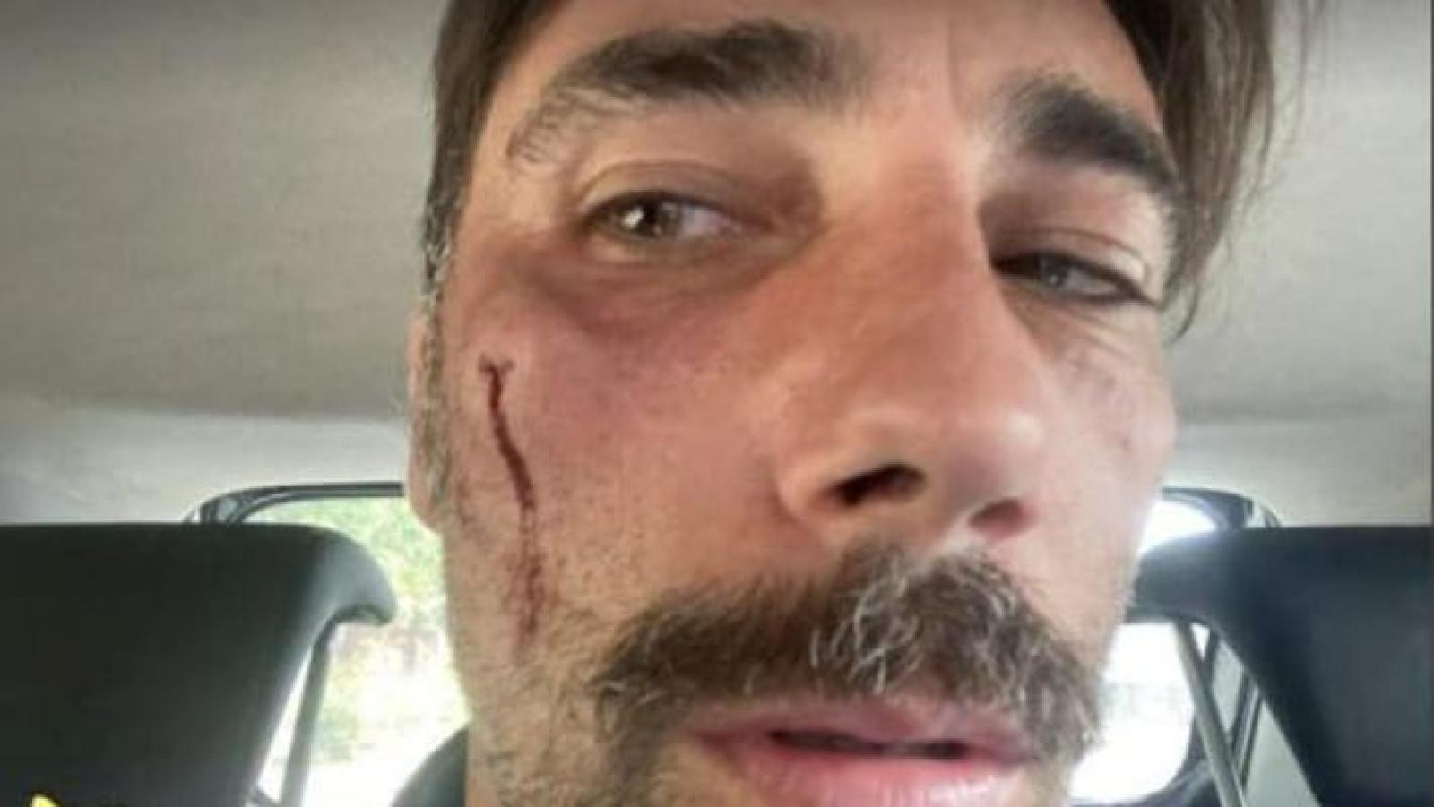 Vittorio Brumotti pestato a sangue, rapinato e minacciato