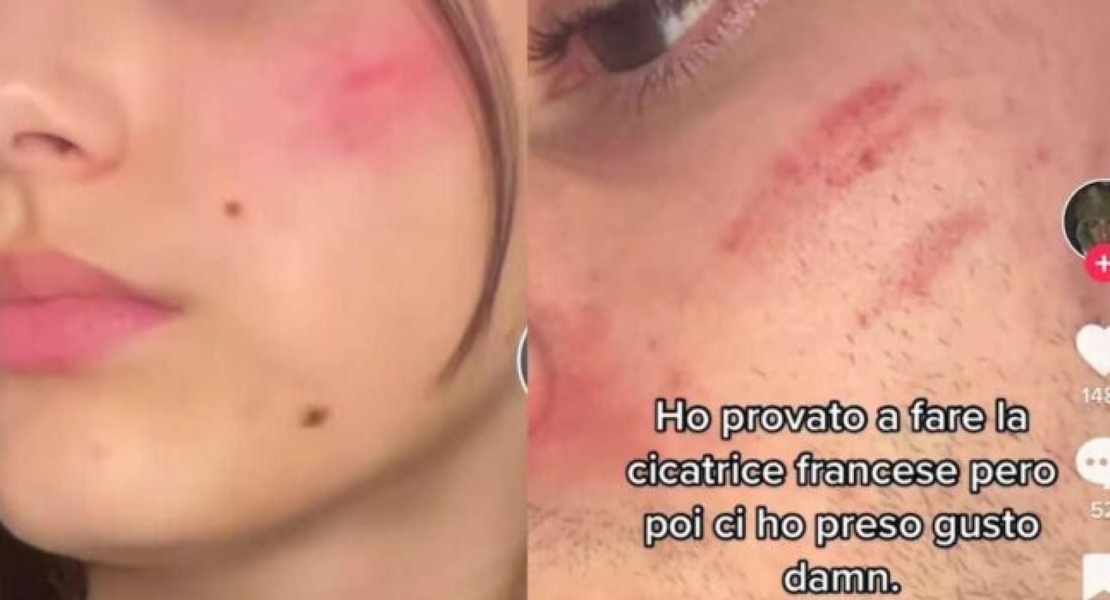 Cicatrice "francese" sul volto, una moda che fa paura