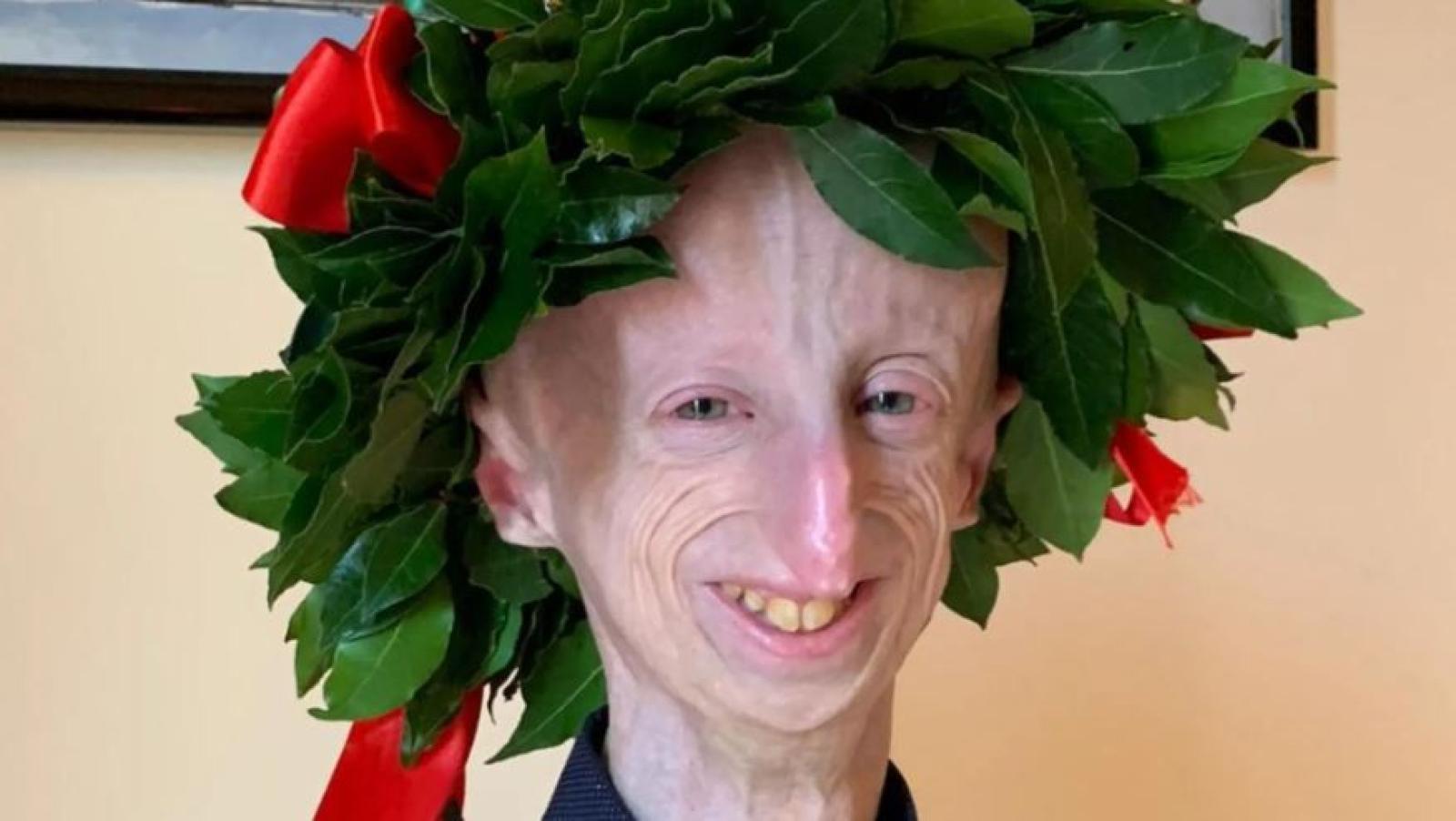 Addio a Sammy Basso: L'Eroe della Progeria e il Suo Impatto Duraturo