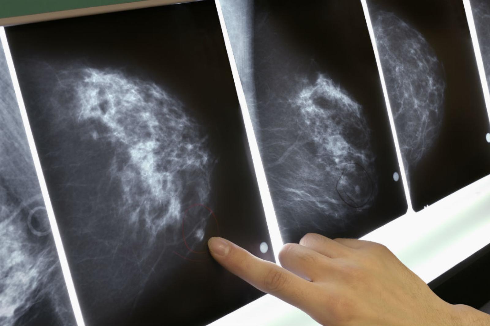 "Tumore non visto": muore a 61 anni