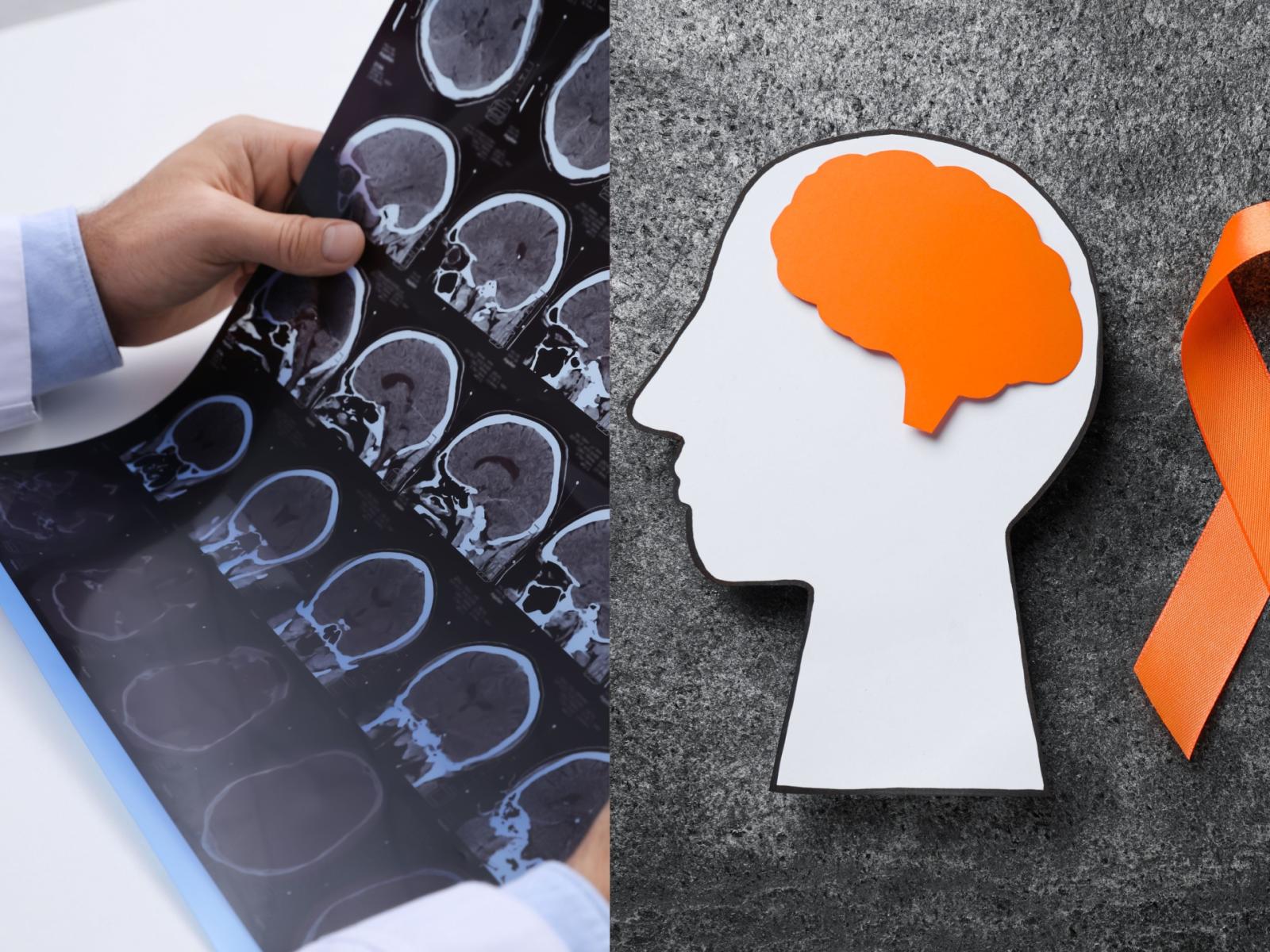 Passi avanti per la Sclerosi Multipla, ora anche l'IA aiuta