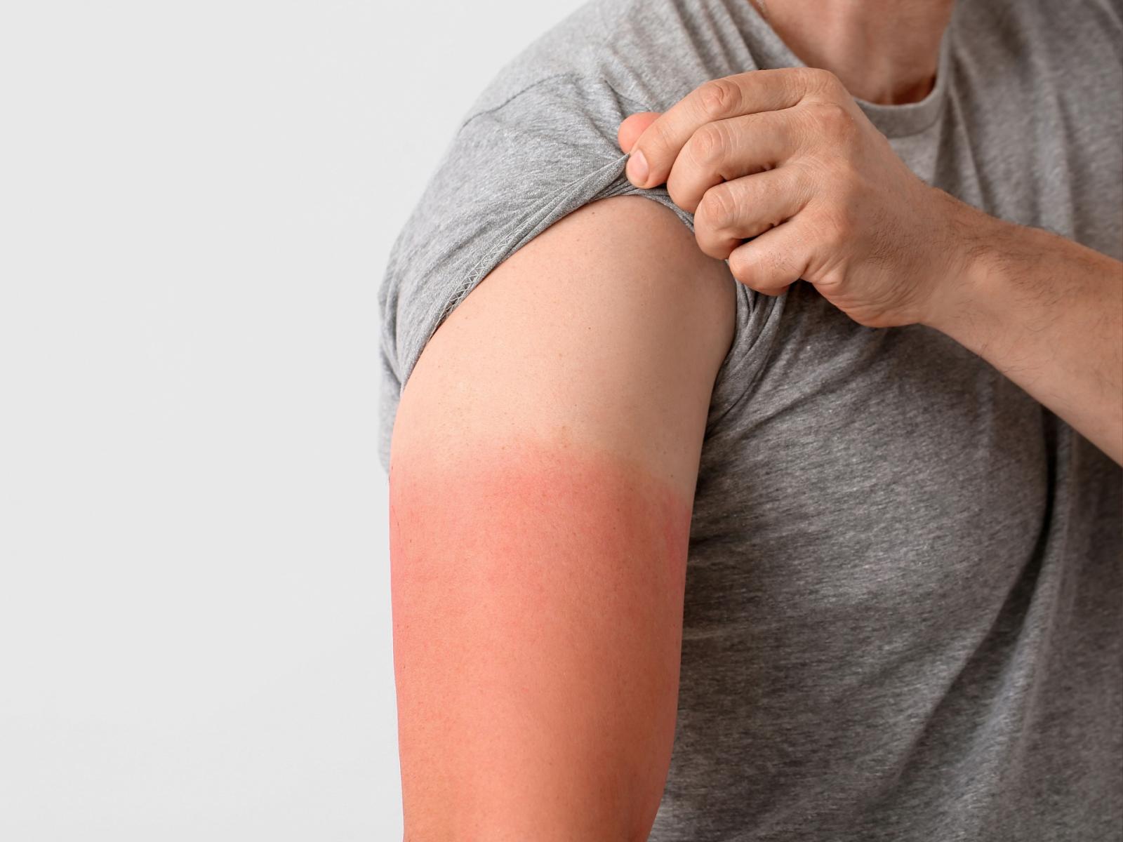 Melanoma: come cinque scottature possono cambiare la tua vita