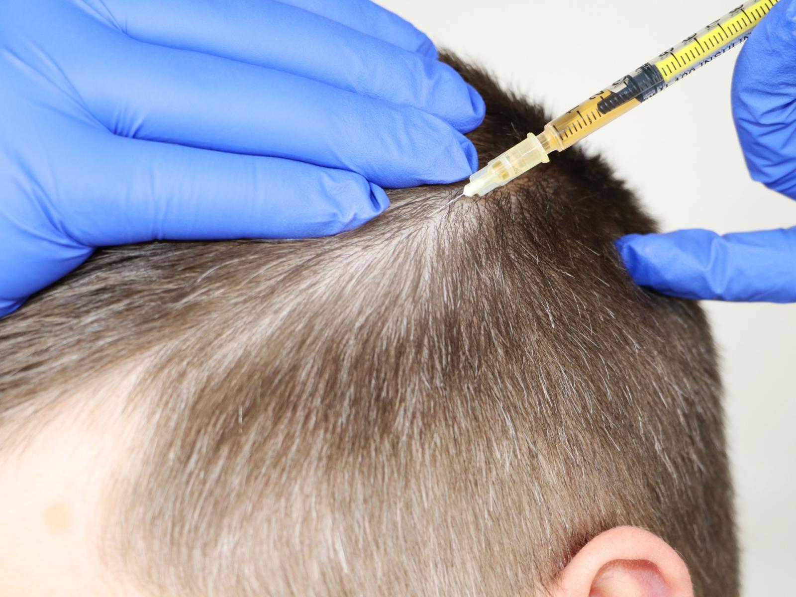 La Turchia: il nuovo paradiso per i trapianti di capelli