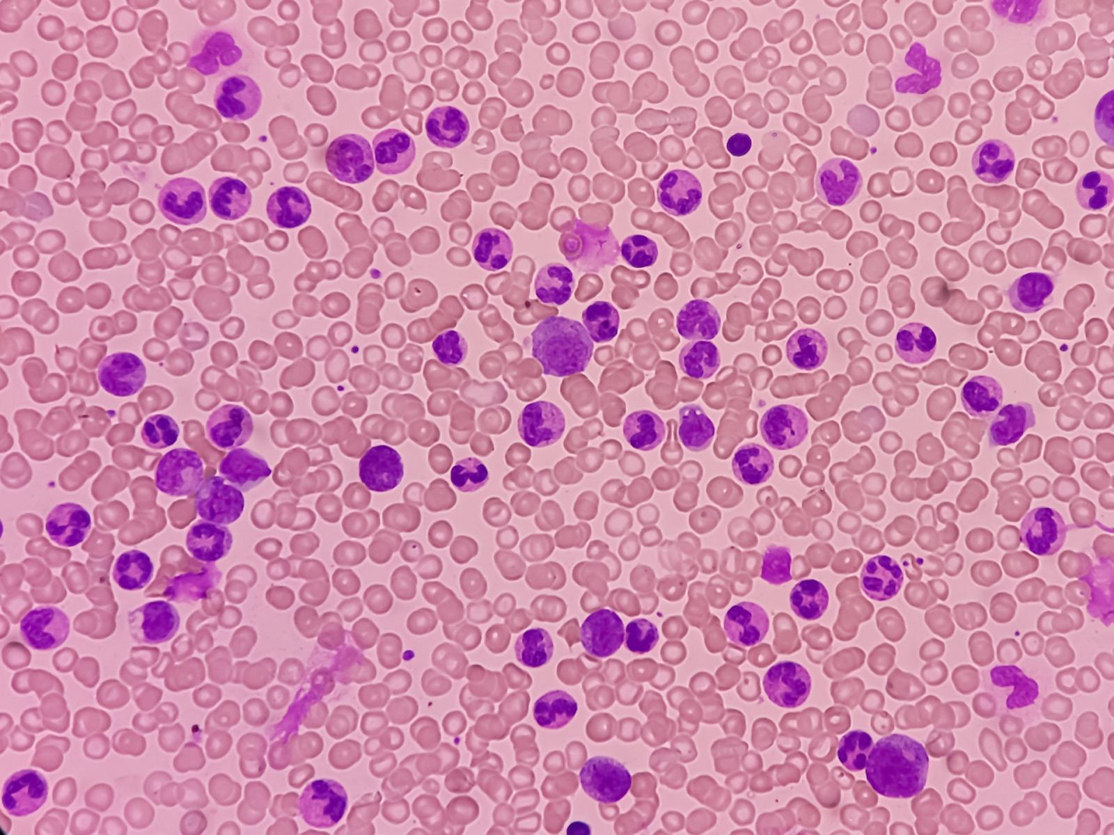 scoperta rivoluzionaria nella lotta alla leucemia: il ruolo chiave degli Rna circolari