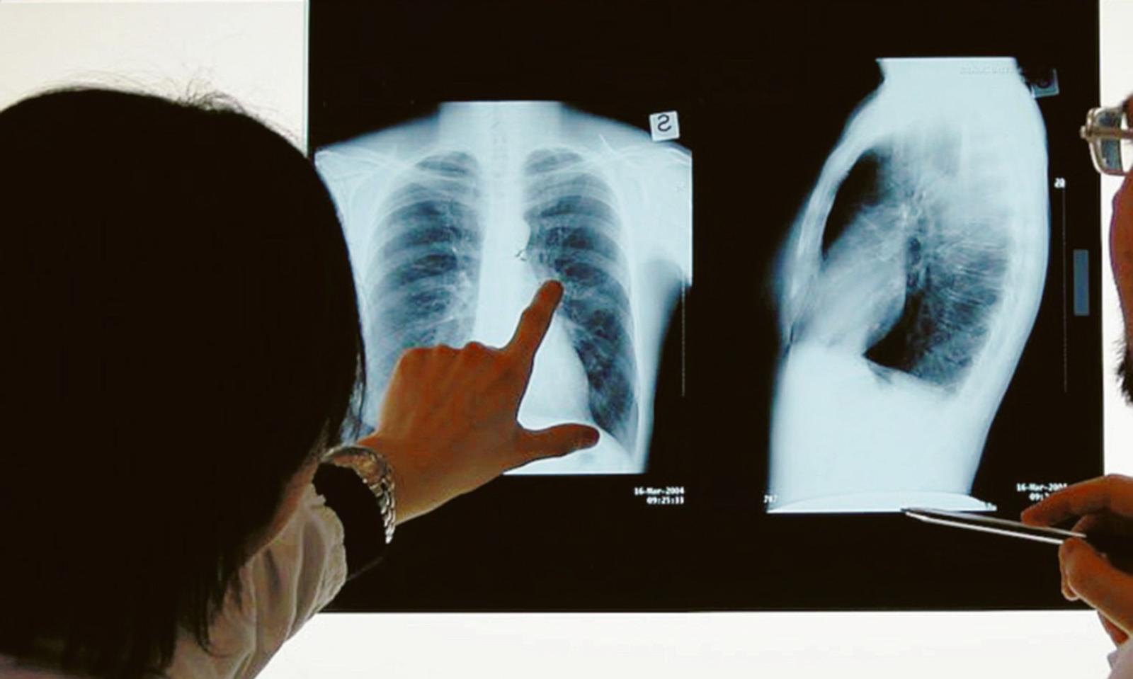 Tbc, profilassi anche in Pediatria a Rovigo