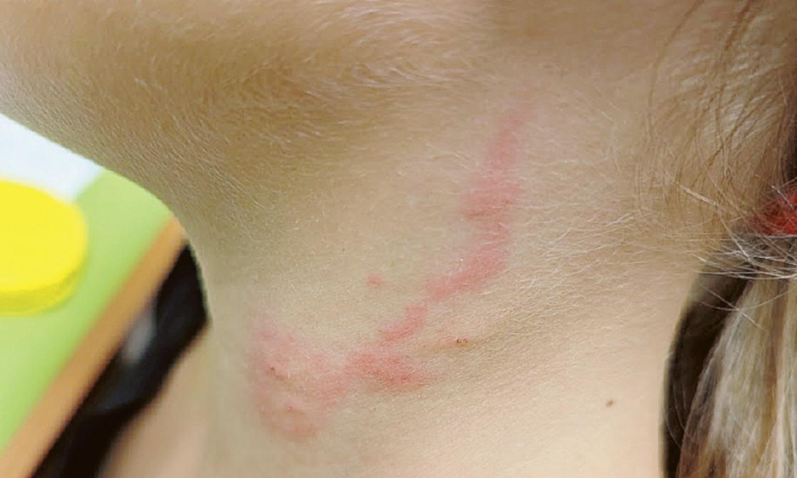 Il giardino di fianco alle scuole &egrave; un disastro: &ldquo;I nostri bimbi, punti dagli insetti&rdquo;