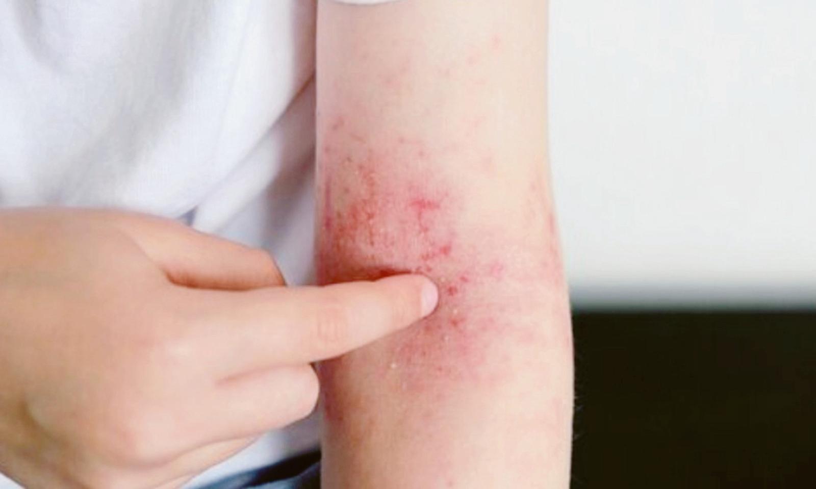 Due casi di scabbia alle primarie