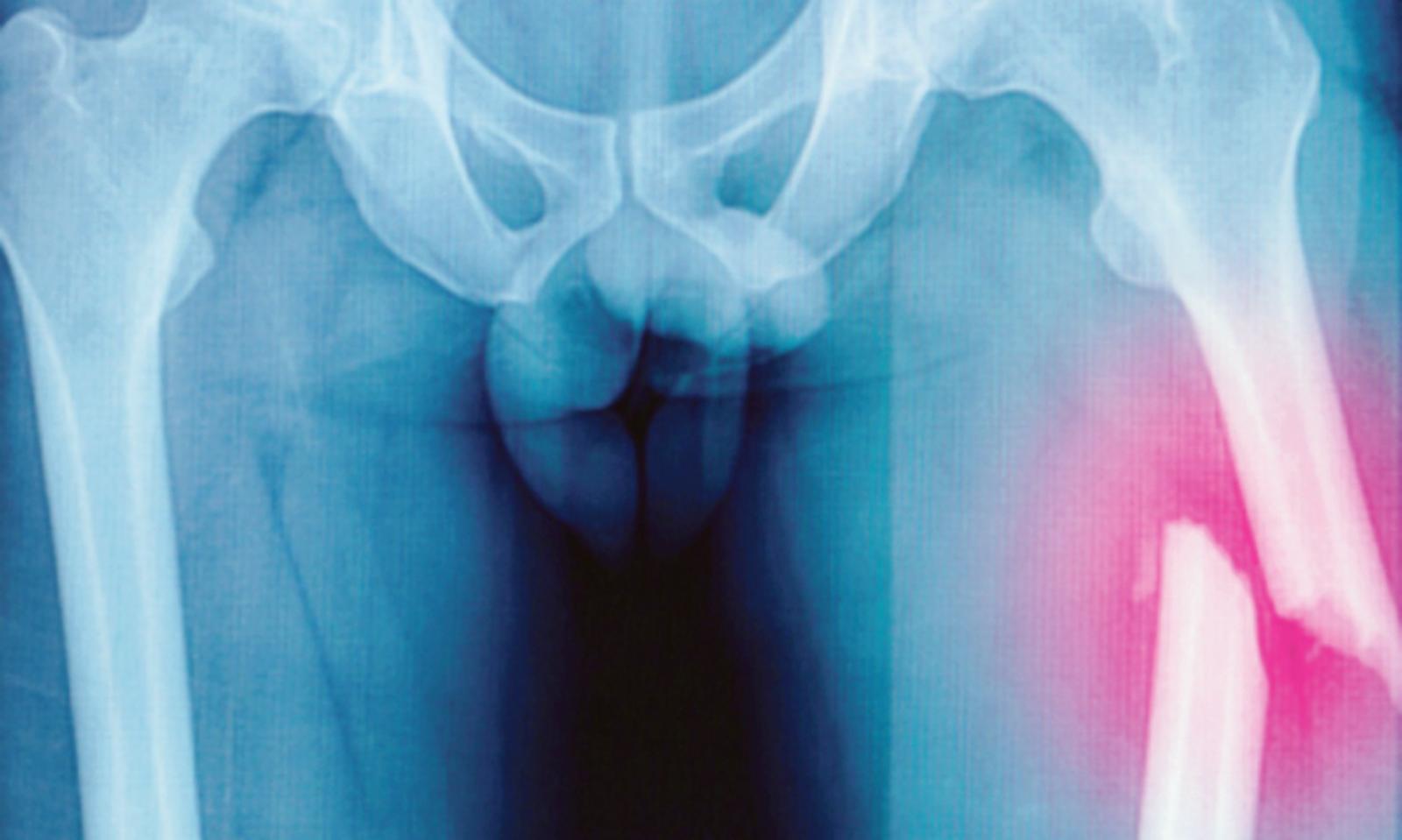 Femore fratturato: attende per un mese l'intervento