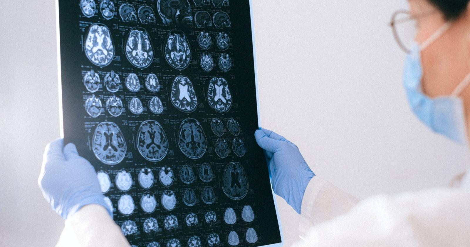 Alice, screening gratuito contro l'ictus