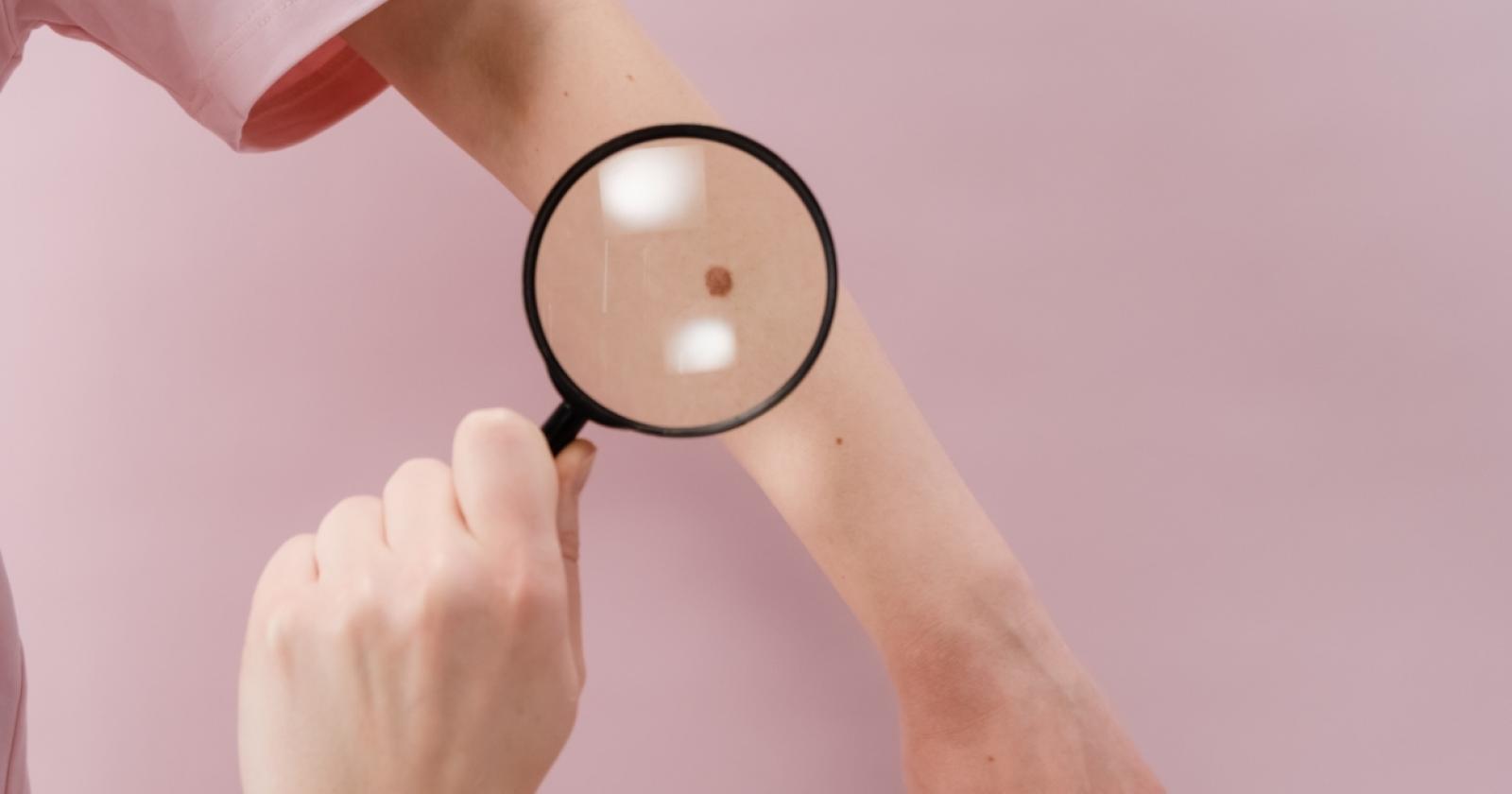 Controlli della pelle contro il melanoma
