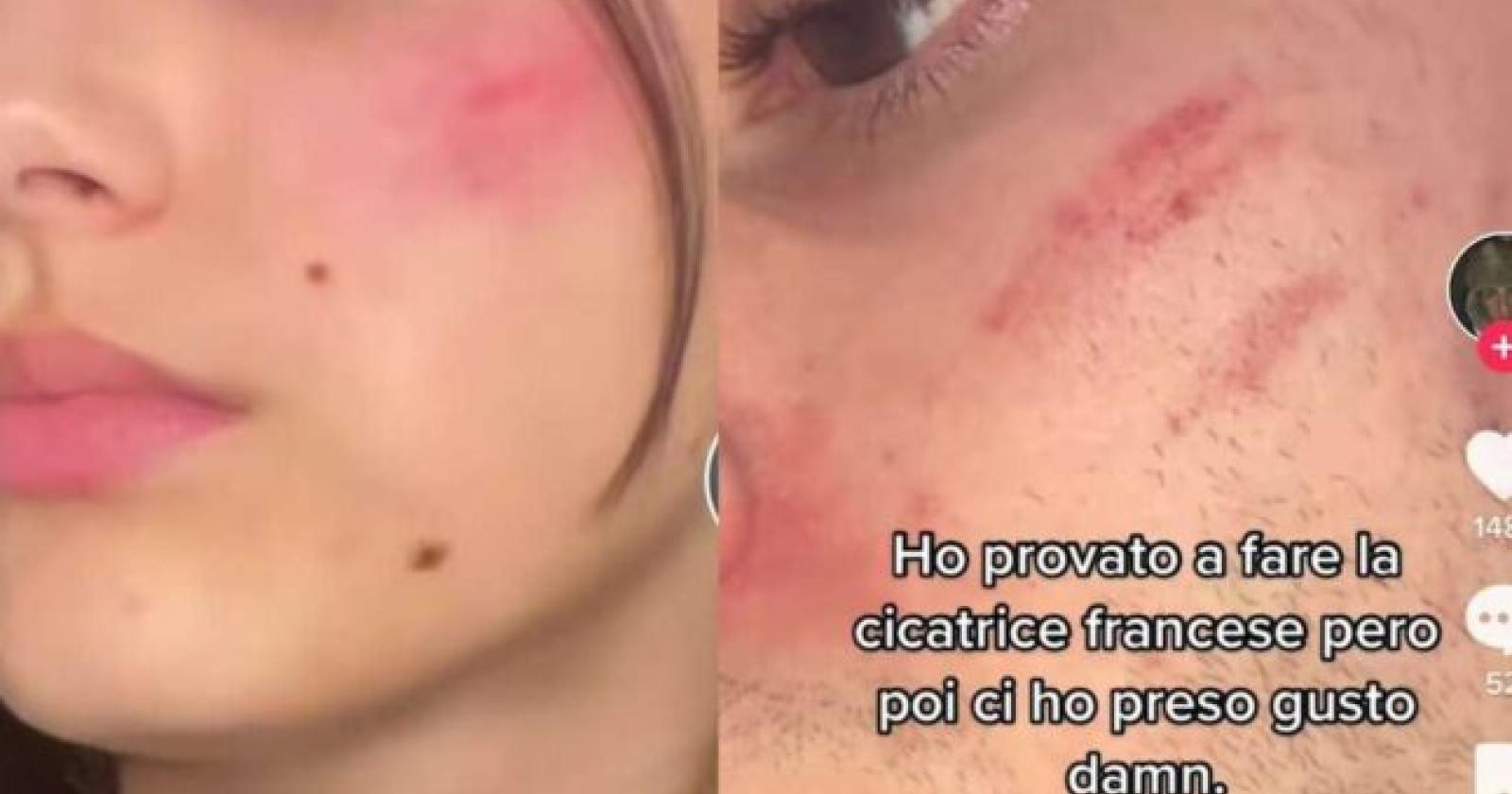 Cicatrice "francese" sul volto, una moda che fa paura