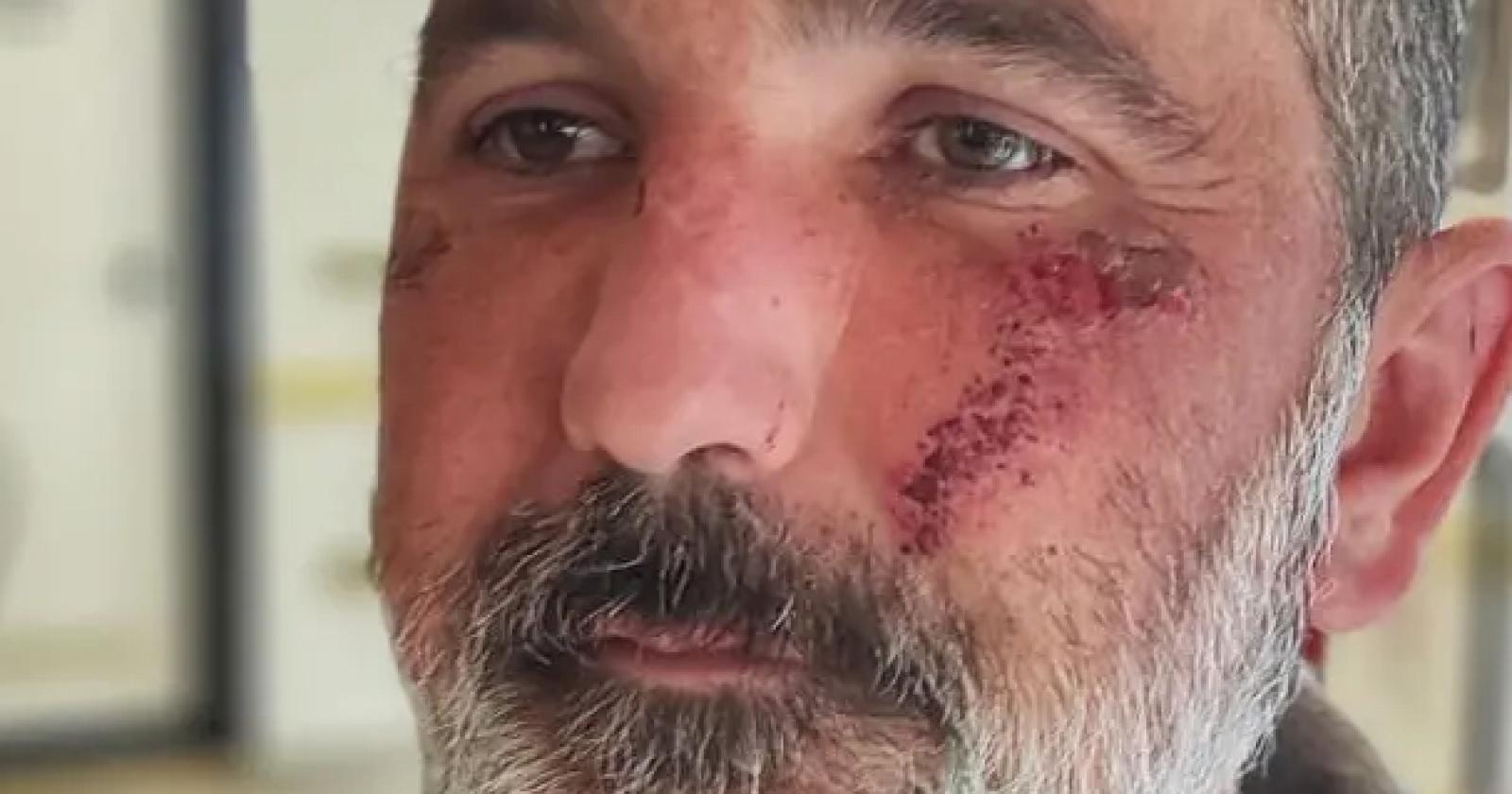 Aggressione omofoba a Cavaso del Tomba: un appuntamento si trasforma in un incubo