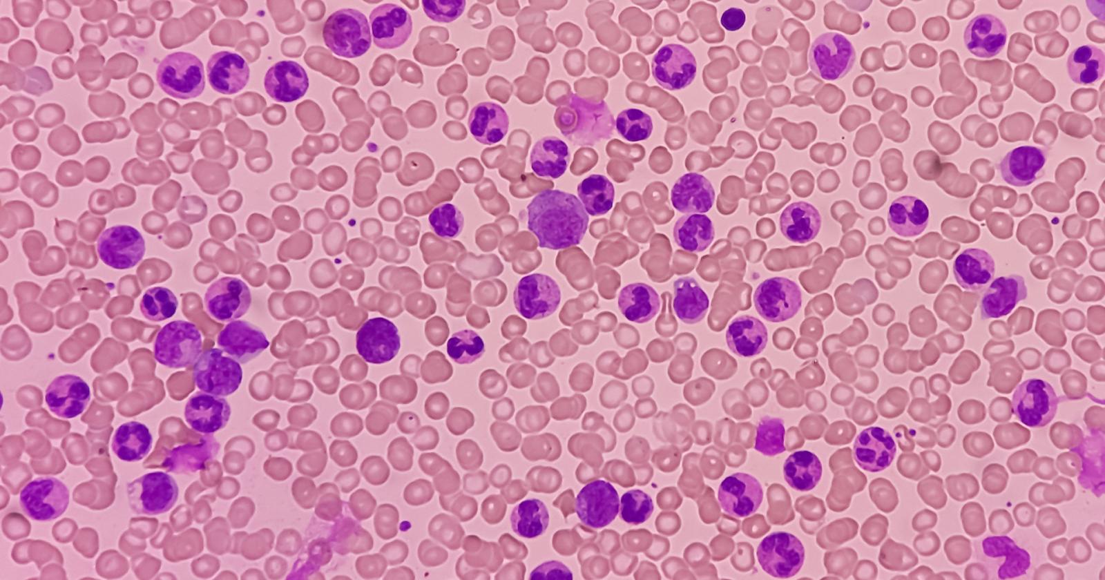 scoperta rivoluzionaria nella lotta alla leucemia: il ruolo chiave degli Rna circolari