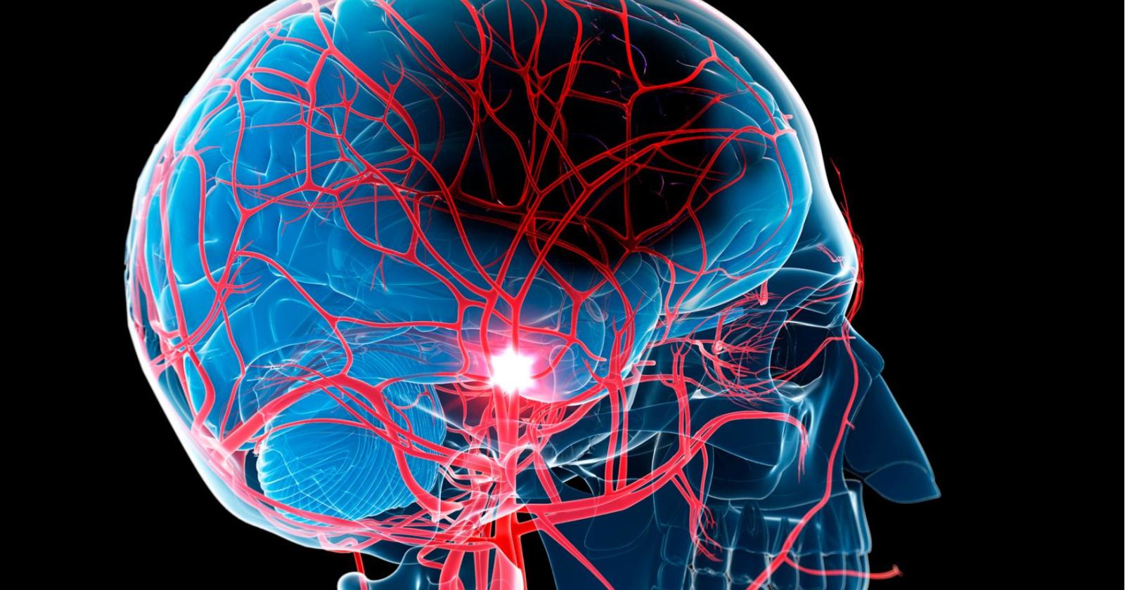 Ictus, riconoscerlo subito