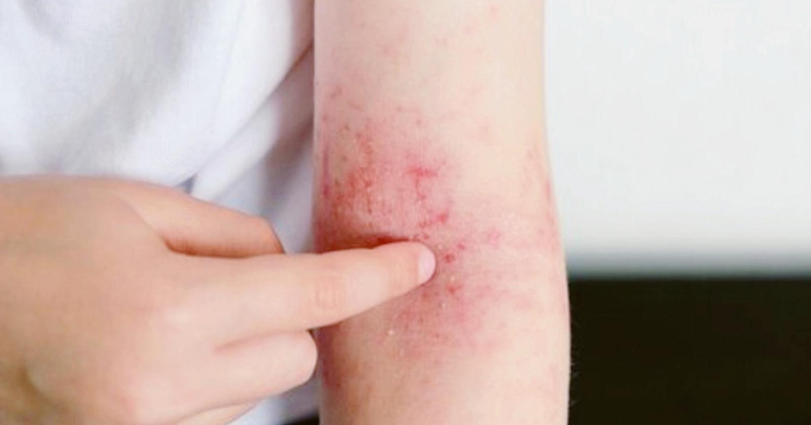 Due casi di scabbia alle primarie