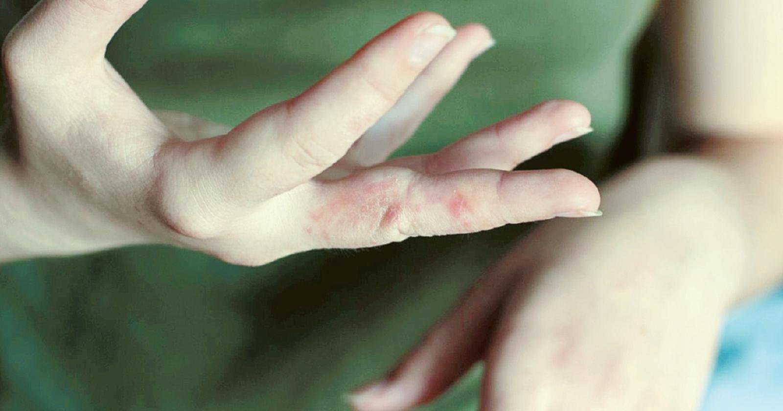 Allarme scabbia al Viola-Marchesini