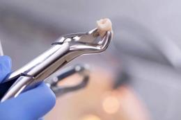 Estrae il dente sbagliato, dentista condannato
