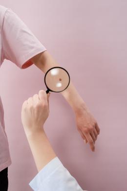 Un neo pericoloso, come prevenire il melanoma