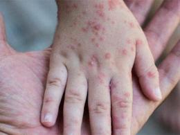 Sei casi di vaiolo delle scimmie, ma arriva il vaccino