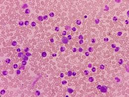 Leucemia, scoperta rivoluzionaria