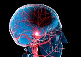 Ictus, riconoscerlo subito
