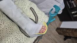 "Picchiato dai buttafuori": ha una gamba rotta