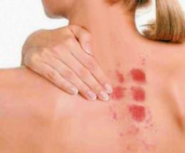 Odissea per trovare un allergologo