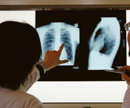 Tbc, profilassi anche in Pediatria a Rovigo