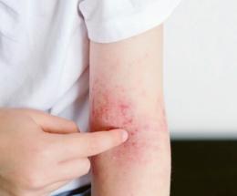 Due casi di scabbia alle primarie